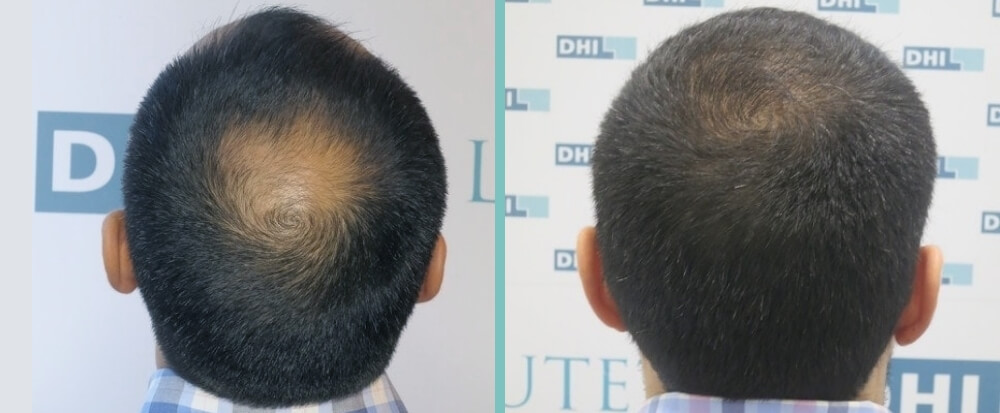 vorher-nachher-daniel-a-2 Vorher Nachher Bild Haartransplantation