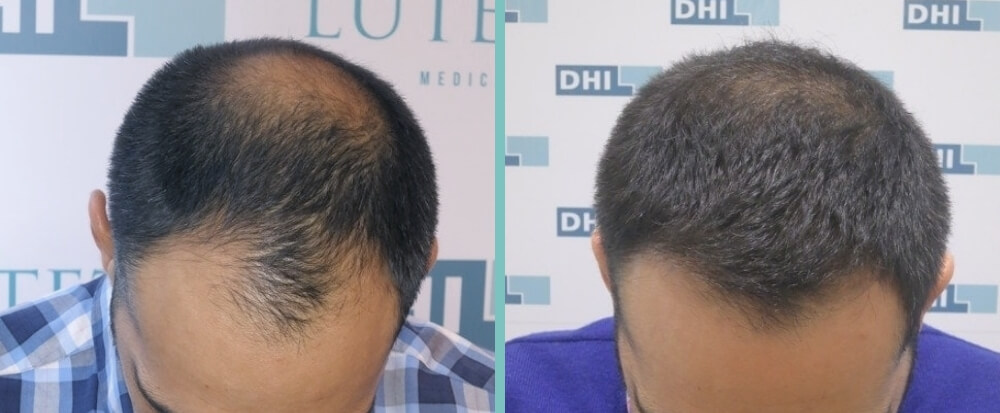 before-after-daniel-a Man with hands in his hair