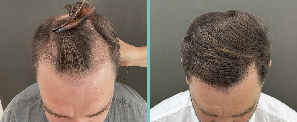 vorher nachher Haartransplantation