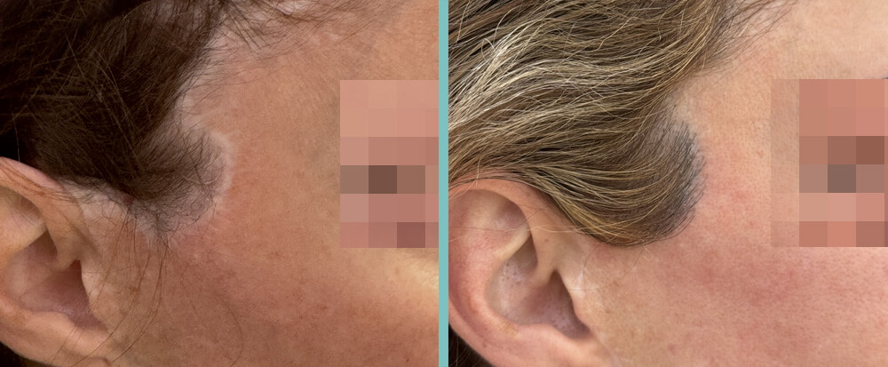 Frau Haartransplantation vorher / nachher